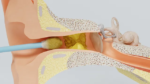 Ear Wax Removal1 150x84