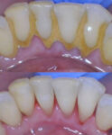 The Smile Suite - Before and After