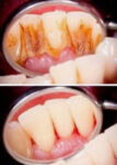 The Smile Suite - Plaque Removal